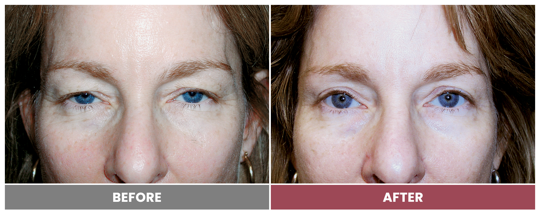Upper Blepharoplasty - Case 20